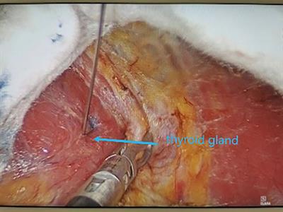 Efficacy of parathyroid autotransplantation in endoscopic total thyroidectomy with CLND